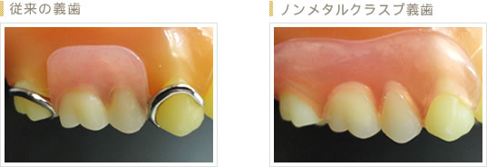 ノンクラスプデンチャー
